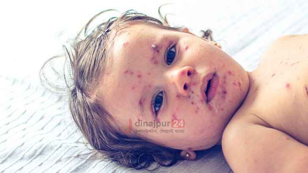 ২৪ ঘণ্টায় সন্দেহজনক হামে আক্রান্ত ৯৪৭, মৃত্যু ৩