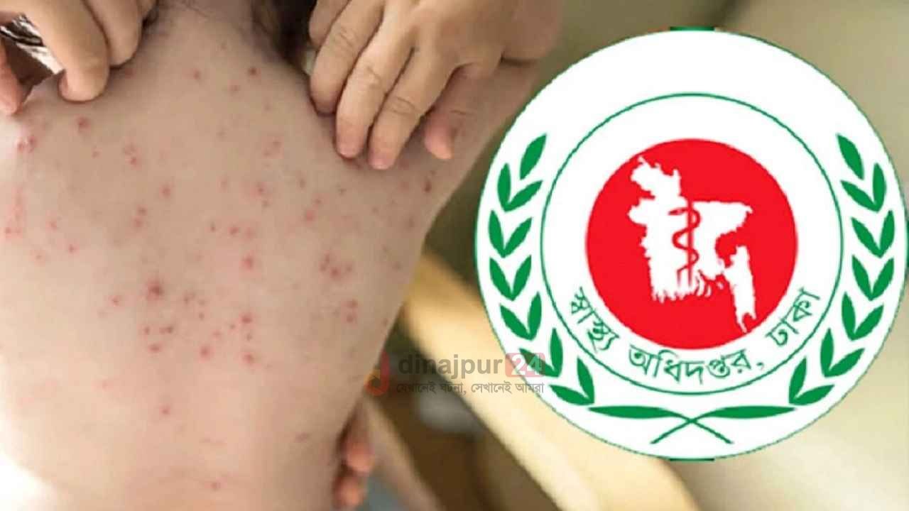 এক মাসে হাম ও উপসর্গ নিয়ে মৃত্যু ২০০ ছুঁইছুঁই